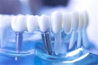 Restoratif ve Konservatif Diş Tedavi İşlemleri