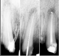 Kanal (Endodonti) Tedavisi