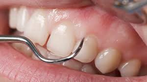 Diş Eti Hastalıkları Tedavisi