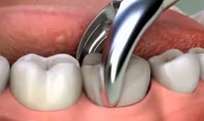 Diş Çekimi ve Cerrahisi
